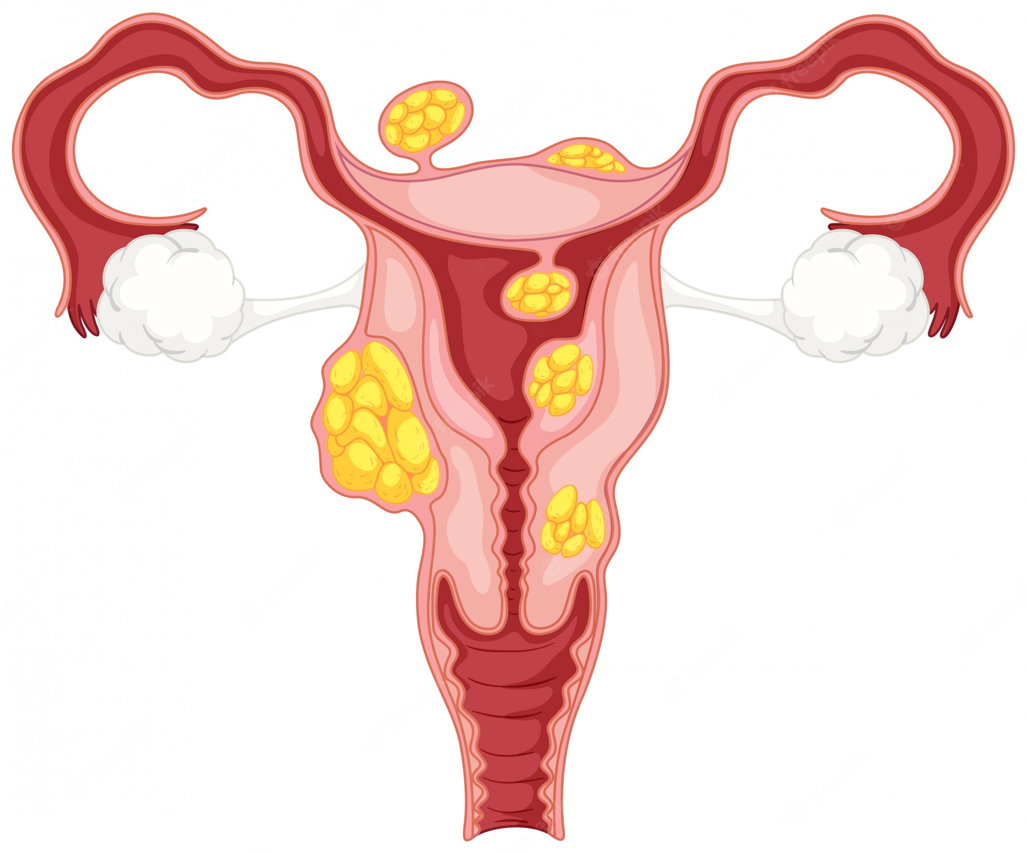 Fibroids Treatment